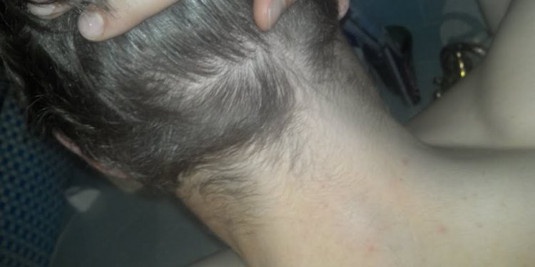 Shaving head after hair Transplant