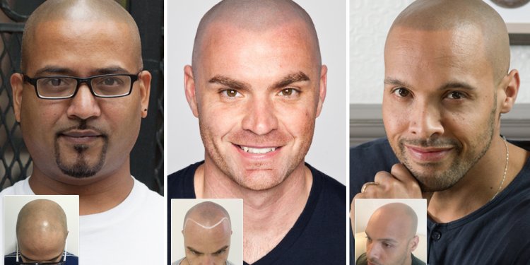 Shaved head after hair Transplant