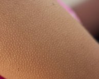 Red bumps after shaving legs